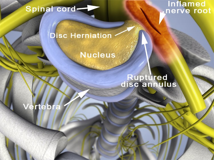 Disc herniations are commonly caused by auto accidents