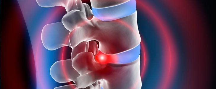 Medical illustration of disc injury and spinal inflammation